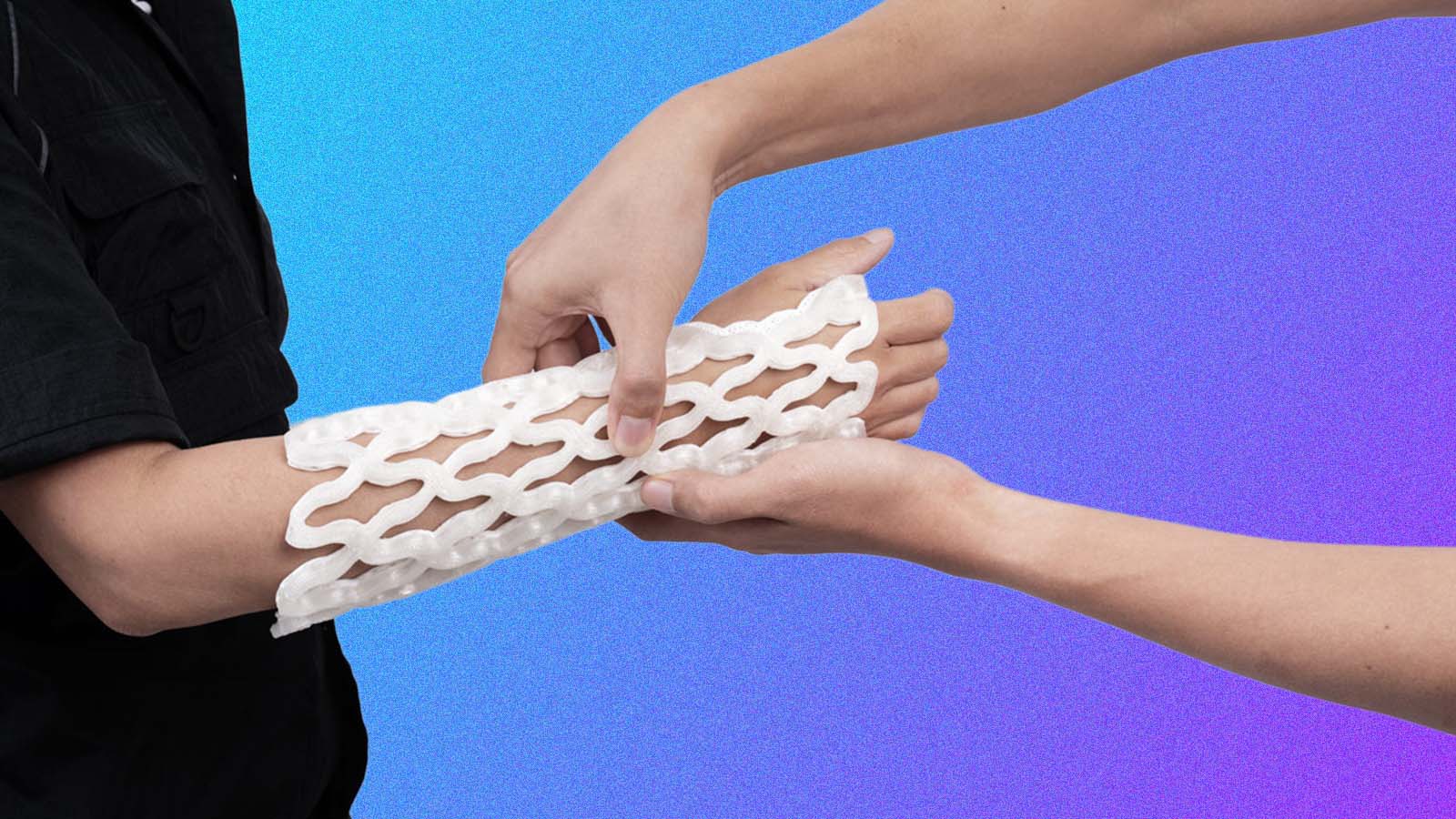 gesso hospitalar impresso em 3D