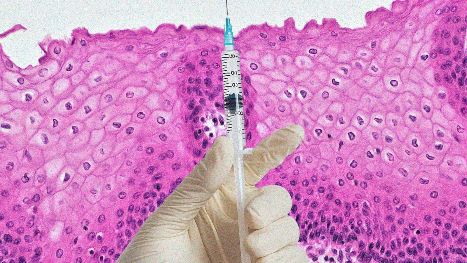 Moderna e Merck têm resultado positivo em teste de vacina contra o melanoma